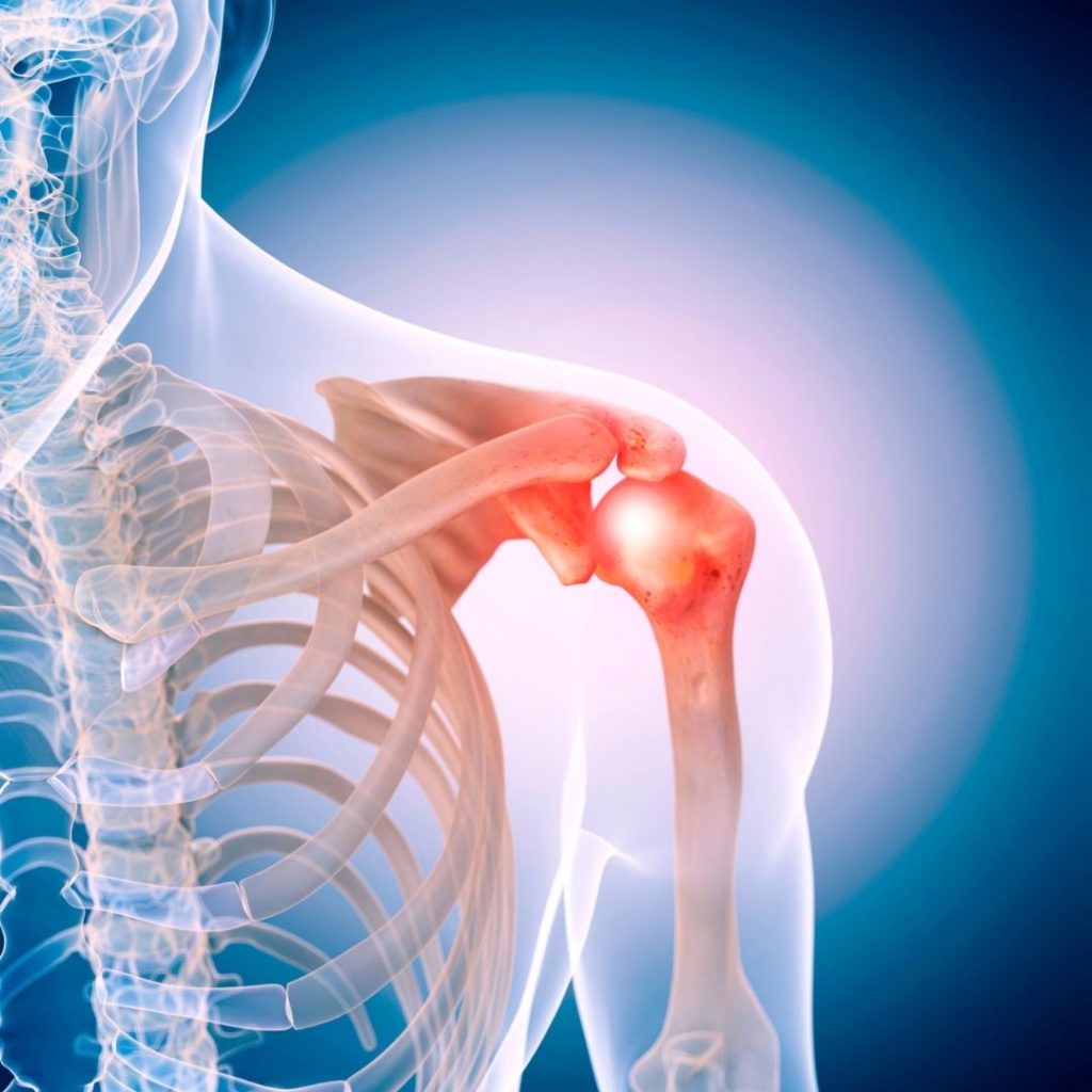 Physical therapy for shoulder pain in New York City